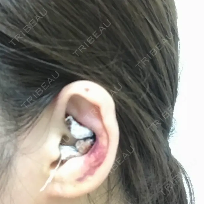 隆鼻術 / 鼻中隔延長（切開） / 軟骨移植 / 鼻修正 / 鼻孔縁下降 加藤クリニック 麻布東京院 DAY 6 メイン用