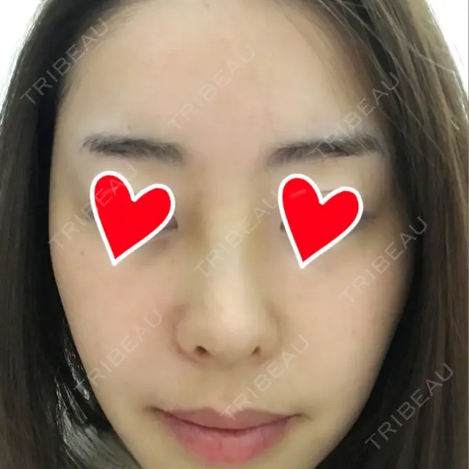 隆鼻術 / 鼻中隔延長（切開） / 軟骨移植 / 鼻修正 / 鼻孔縁下降 加藤クリニック 麻布東京院 DAY 7 メイン用