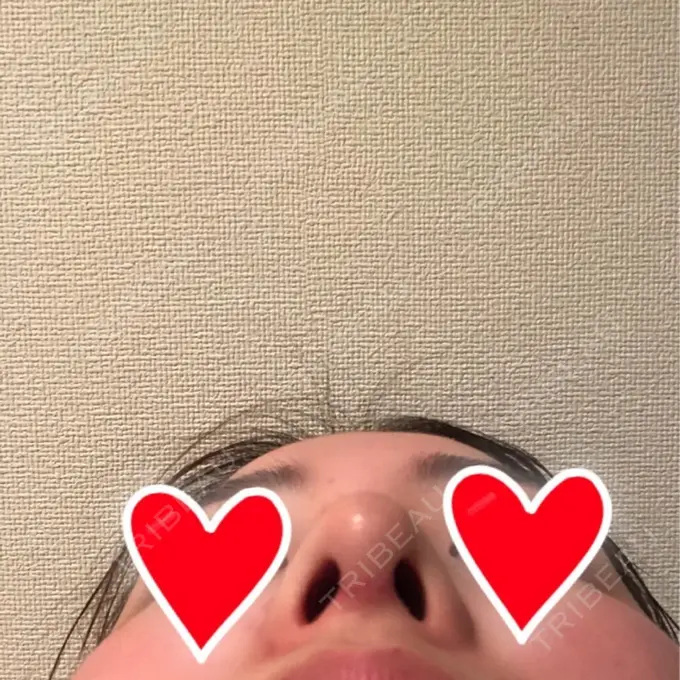 隆鼻術 / 鼻中隔延長（切開） / 軟骨移植 / 鼻修正 / 鼻孔縁下降 加藤クリニック 麻布東京院 DAY 7 メイン用