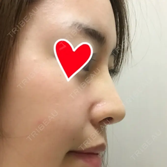 隆鼻術 / 鼻中隔延長（切開） / 軟骨移植 / 鼻修正 / 鼻孔縁下降 加藤クリニック 麻布東京院 DAY 7 メイン用