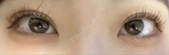 二重埋没 城本クリニック 福岡院 DAY 836 メイン用