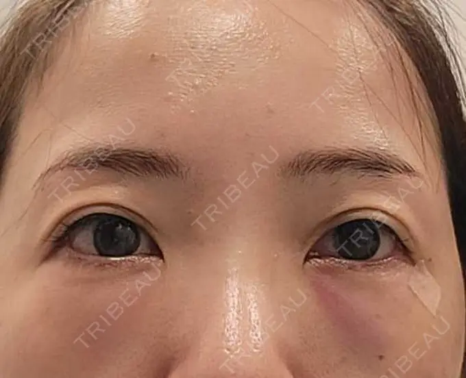 クマ治療 / 下まぶたたるみ取り / その他（目元） セオリークリニック DAY 1 メイン用