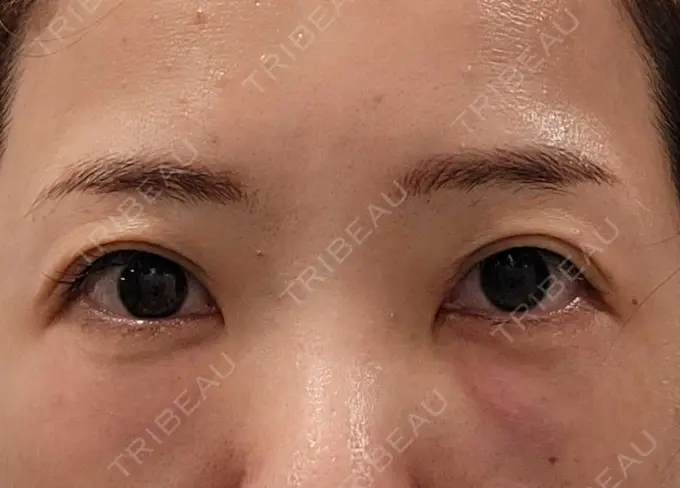 クマ治療 / 下まぶたたるみ取り / その他（目元） セオリークリニック DAY 2 メイン用