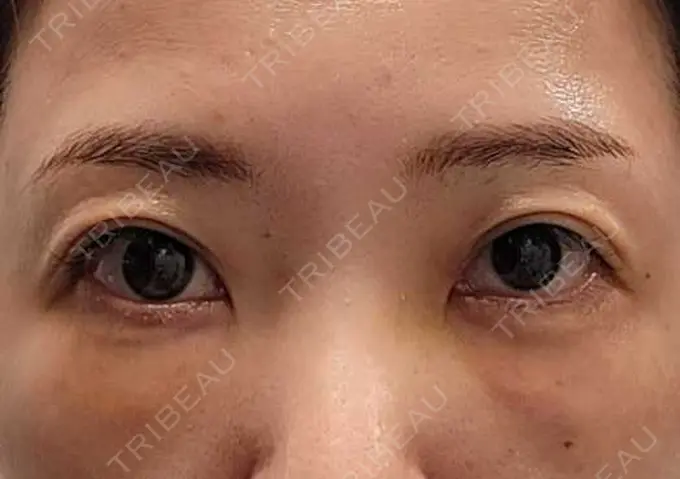 クマ治療 / 下まぶたたるみ取り / その他（目元） セオリークリニック DAY 3 メイン用