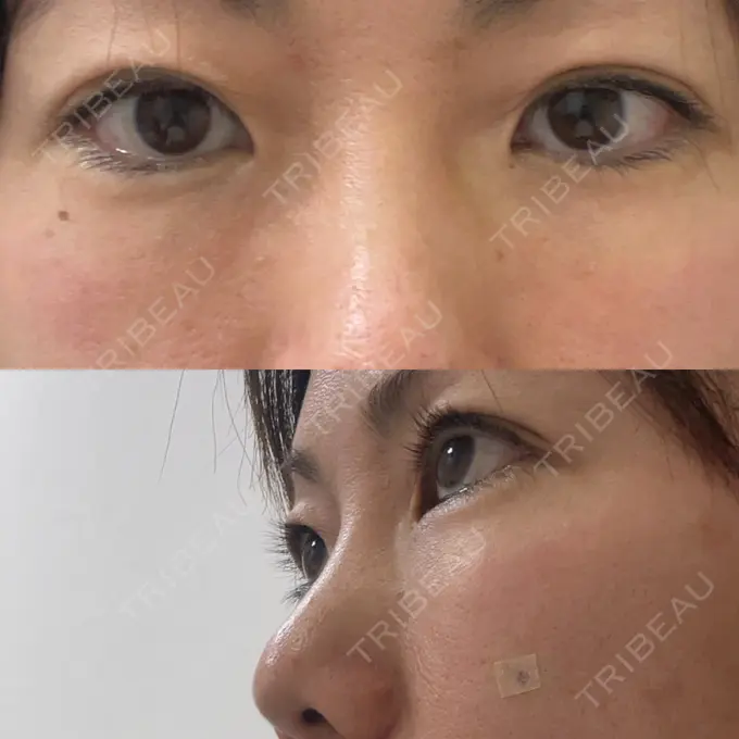 下まぶたたるみ取り セオリークリニック DAY 0 メイン用