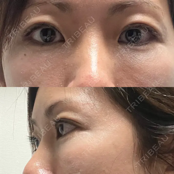 下まぶたたるみ取り セオリークリニック DAY 0 メイン用