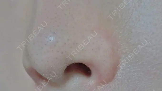 鼻孔縁挙上 シエルクリニック DAY 35 メイン用