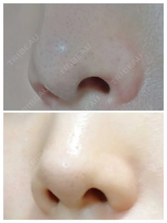 鼻孔縁挙上 シエルクリニック DAY 35 メイン用