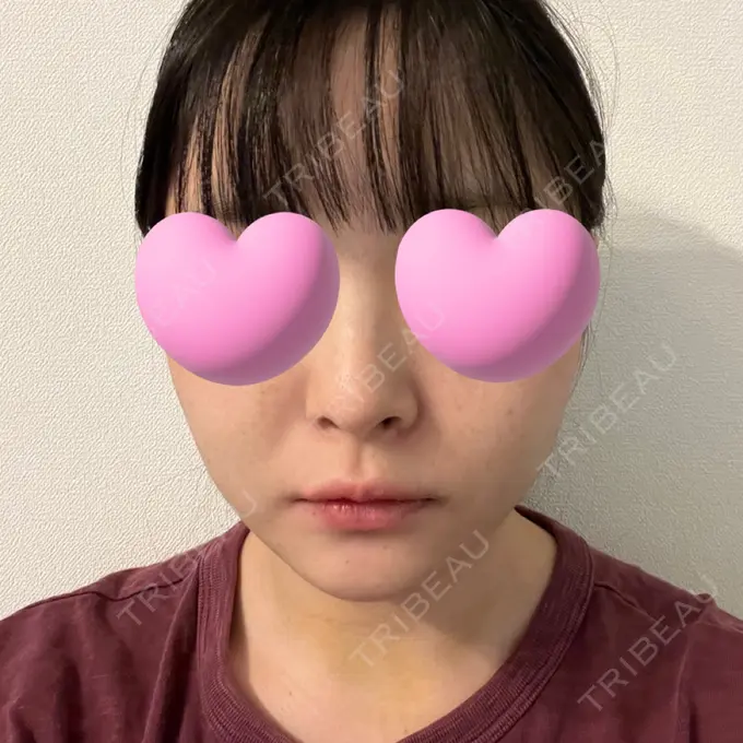 糸リフト / 脂肪吸引（顔） / ジョールファット除去 東京シンデレラ美容外科 池袋院 DAY 11 メイン用