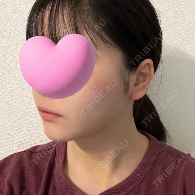 糸リフト / 脂肪吸引（顔） / ジョールファット除去 東京シンデレラ美容外科 池袋院 DAY 11 メイン用