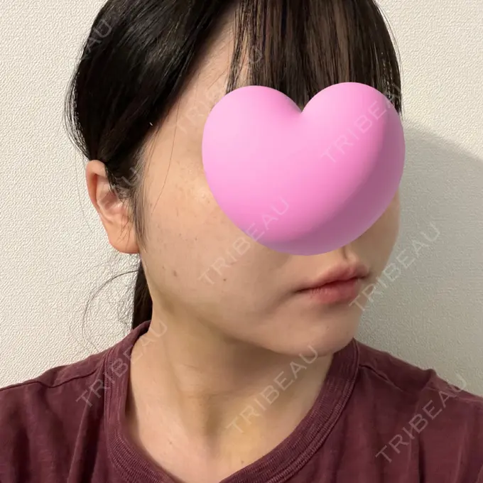 糸リフト / 脂肪吸引（顔） / ジョールファット除去 東京シンデレラ美容外科 池袋院 DAY 11 メイン用