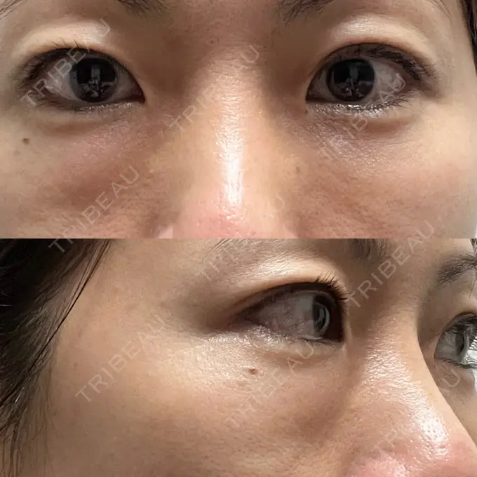 下まぶたたるみ取り セオリークリニック DAY 1 メイン用