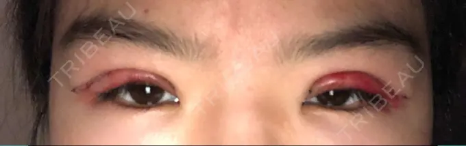 二重切開 / 上まぶたの脂肪取り ブリスクリニック形成外科・美容外科・美容皮膚科 福岡 DAY 1 メイン用