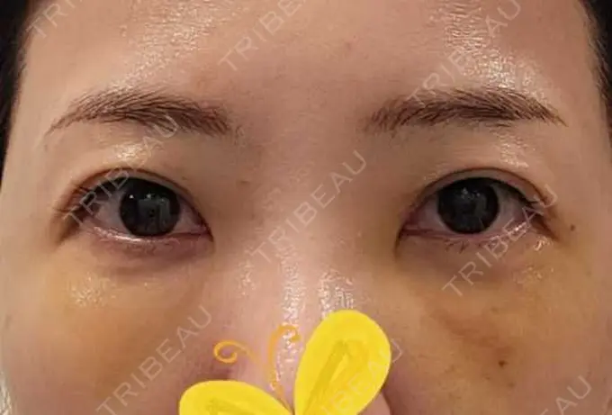 クマ治療 / 下まぶたたるみ取り / その他（目元） セオリークリニック DAY 5 メイン用