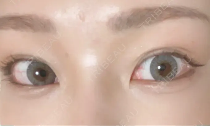 ヒアルロン酸注入（涙袋） / ボトックス（眉間） TCB東京中央美容外科 宇都宮院 DAY 0 メイン用