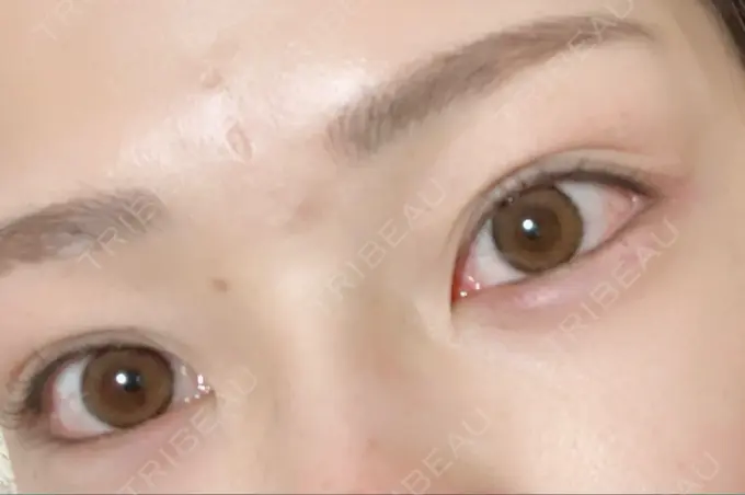 ヒアルロン酸注入（涙袋） / ボトックス（眉間） TCB東京中央美容外科 宇都宮院 DAY 3 メイン用