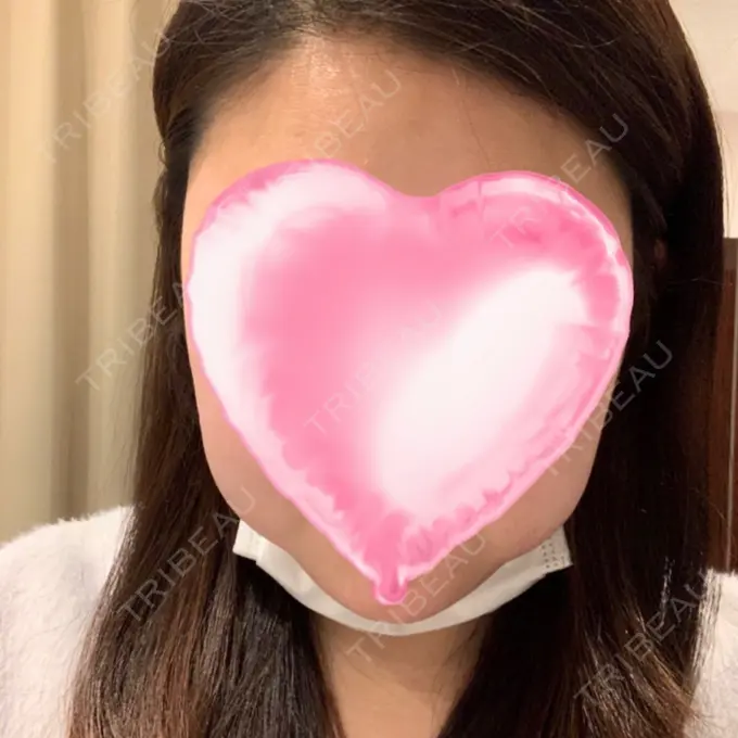 ボトックス（エラ・小顔） / 脂肪溶解注射（顔） 湘南美容クリニック 名古屋栄院 DAY 0 メイン用