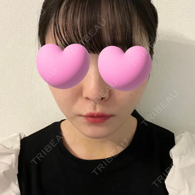 糸リフト / 脂肪吸引（顔） / ジョールファット除去 東京シンデレラ美容外科 池袋院 DAY 12 メイン用