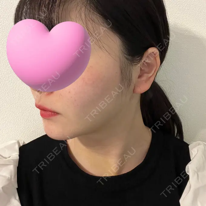 糸リフト / 脂肪吸引（顔） / ジョールファット除去 東京シンデレラ美容外科 池袋院 DAY 12 メイン用