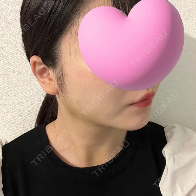 糸リフト / 脂肪吸引（顔） / ジョールファット除去 東京シンデレラ美容外科 池袋院 DAY 12 メイン用