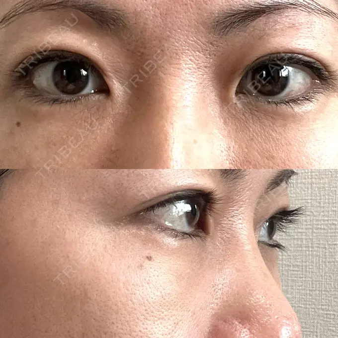 下まぶたたるみ取り セオリークリニック DAY 3 メイン用