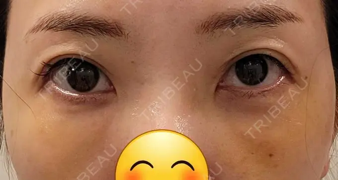 クマ治療 / 下まぶたたるみ取り / その他（目元） セオリークリニック DAY 7 メイン用