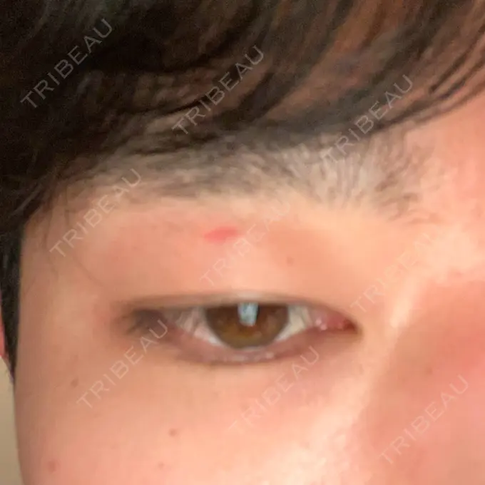 ほくろ・いぼ除去レーザー（肌） エースクリニック 大阪梅田HEPナビオ院 AFTER メイン用