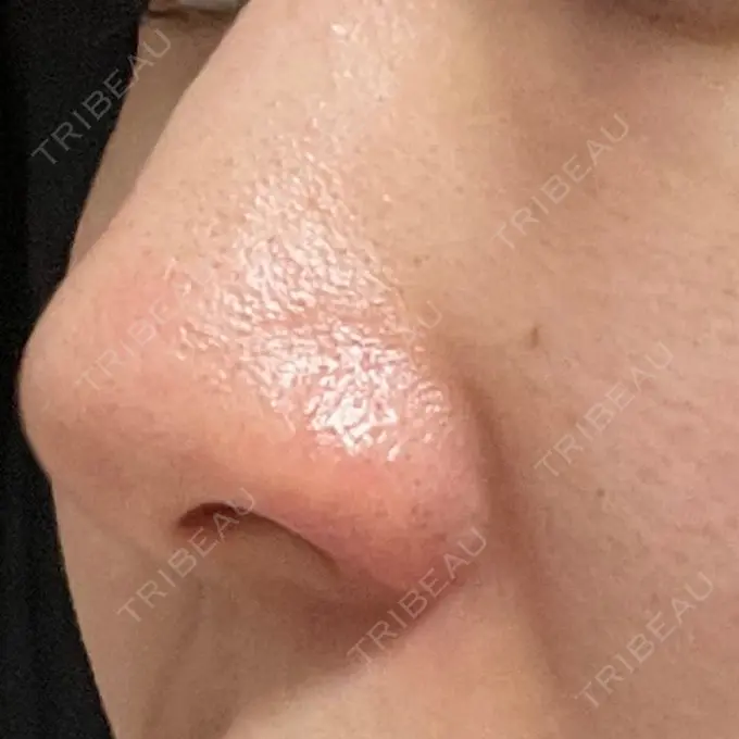 鼻孔縁挙上 シエルクリニック DAY 33 メイン用