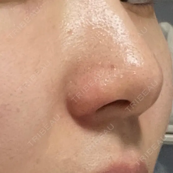 鼻孔縁挙上 シエルクリニック DAY 33 メイン用