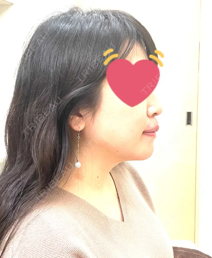 骨切り（あご） / セットバック カトレア歯科・美容クリニック DAY 135 メイン用