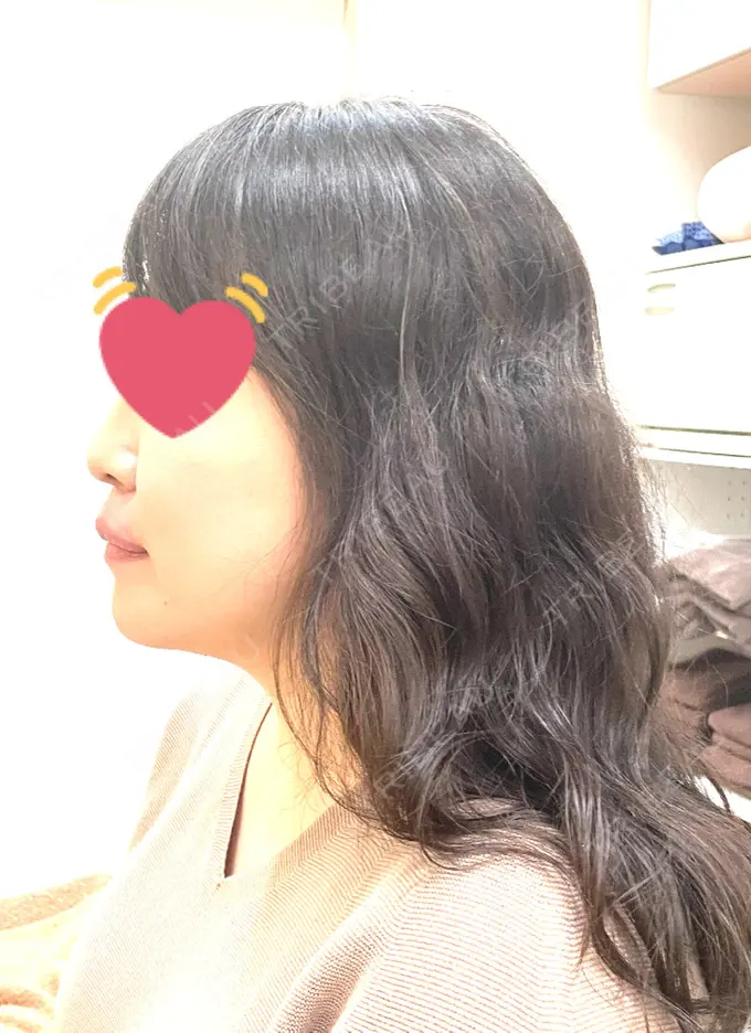 骨切り（あご） / セットバック カトレア歯科・美容クリニック DAY 135 メイン用