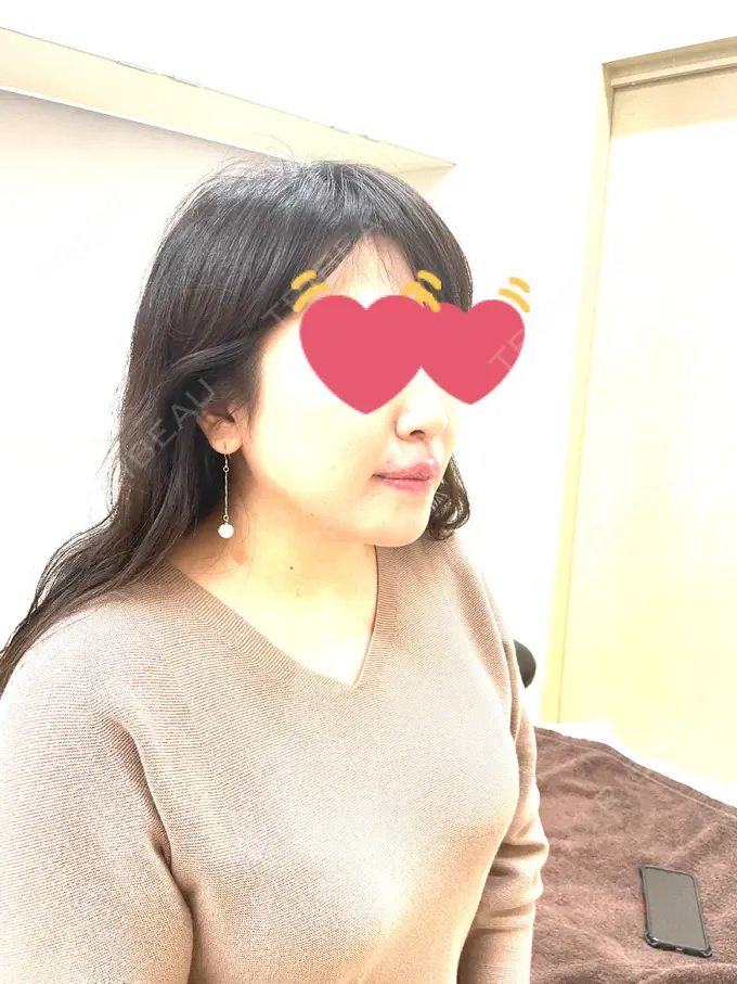 骨切り（あご） / セットバック カトレア歯科・美容クリニック DAY 135 メイン用