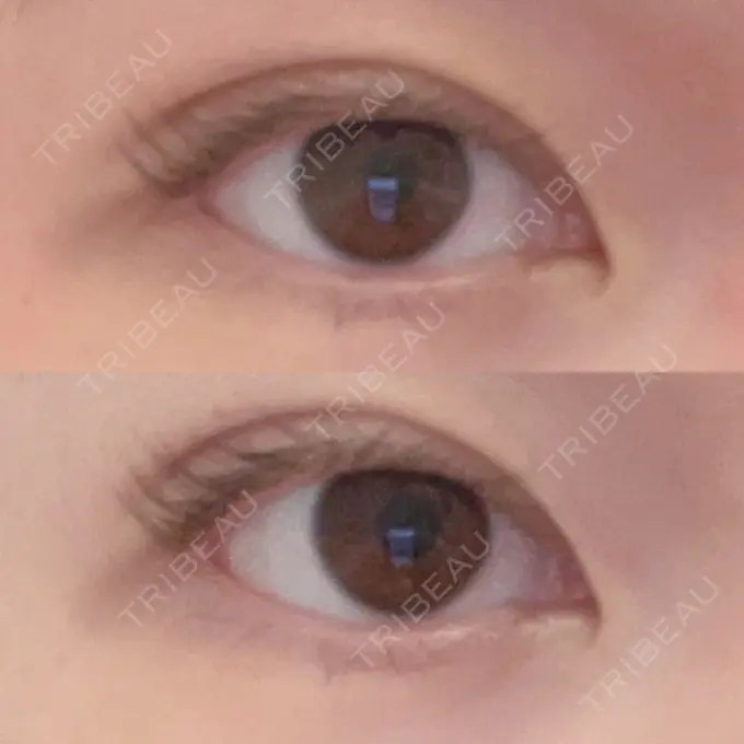 二重埋没 よだ形成外科クリニック DAY 5 メイン用