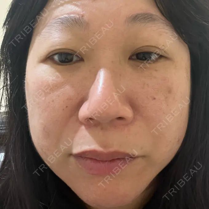 プラセンタ注射 / ピコレーザートーニング（美白・肝斑） フローラクリニック DAY 0 メイン用