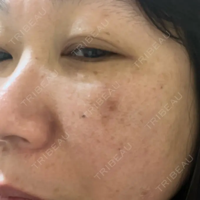 プラセンタ注射 / ピコレーザートーニング（美白・肝斑） フローラクリニック DAY 0 メイン用