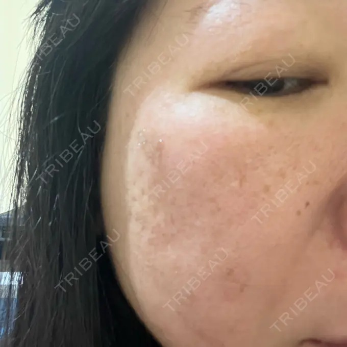 プラセンタ注射 / ピコレーザートーニング（美白・肝斑） フローラクリニック DAY 0 メイン用