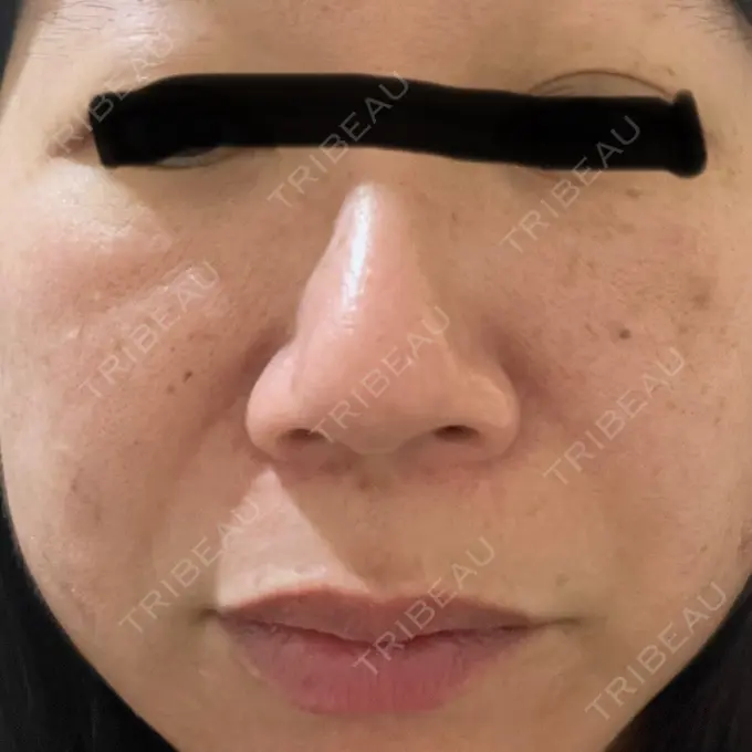 プラセンタ注射 / ピコレーザートーニング（美白・肝斑） フローラクリニック DAY 0 メイン用