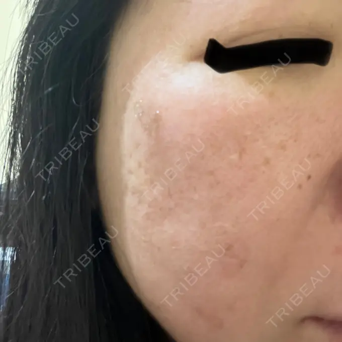 プラセンタ注射 / ピコレーザートーニング（美白・肝斑） フローラクリニック DAY 0 メイン用