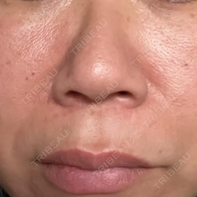 プラセンタ注射 / ピコレーザートーニング（美白・肝斑） フローラクリニック AFTER メイン用