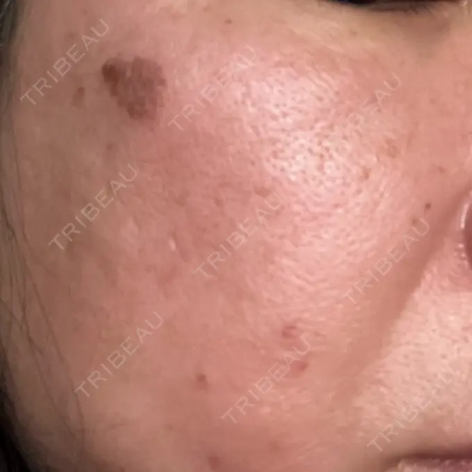 プラセンタ注射 / ピコレーザートーニング（美白・肝斑） フローラクリニック DAY 1 メイン用