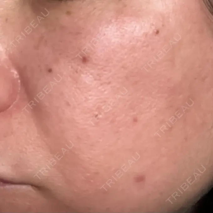 プラセンタ注射 / ピコレーザートーニング（美白・肝斑） フローラクリニック DAY 1 メイン用