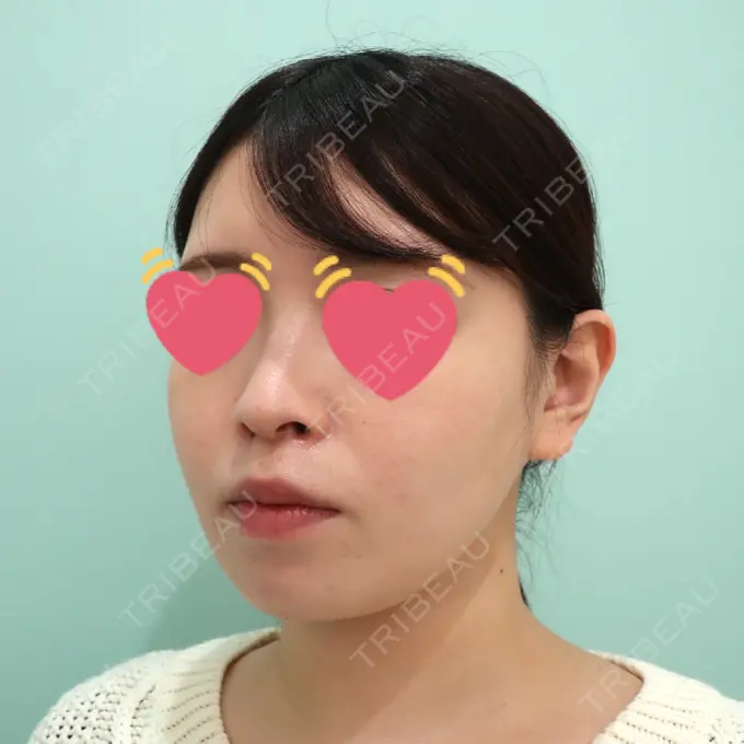 脂肪吸引（顔） / 脂肪冷却（輪郭） WOM CLINIC GINZA （ワム クリニック ギンザ） DAY 94 メイン用