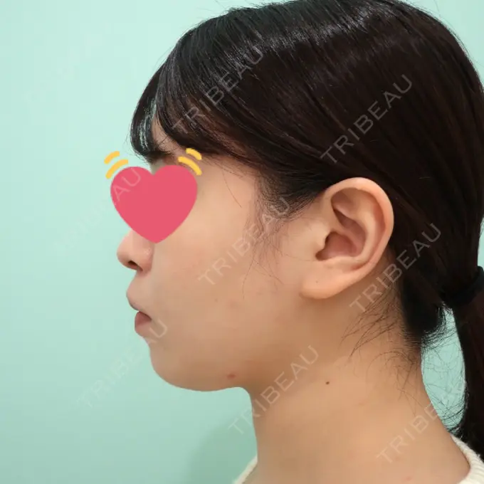 脂肪吸引（顔） / 脂肪冷却（輪郭） WOM CLINIC GINZA （ワム クリニック ギンザ） DAY 94 メイン用