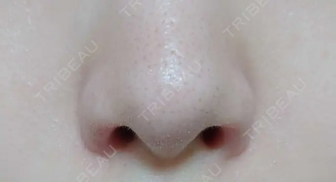 鼻孔縁挙上 シエルクリニック DAY 40 メイン用