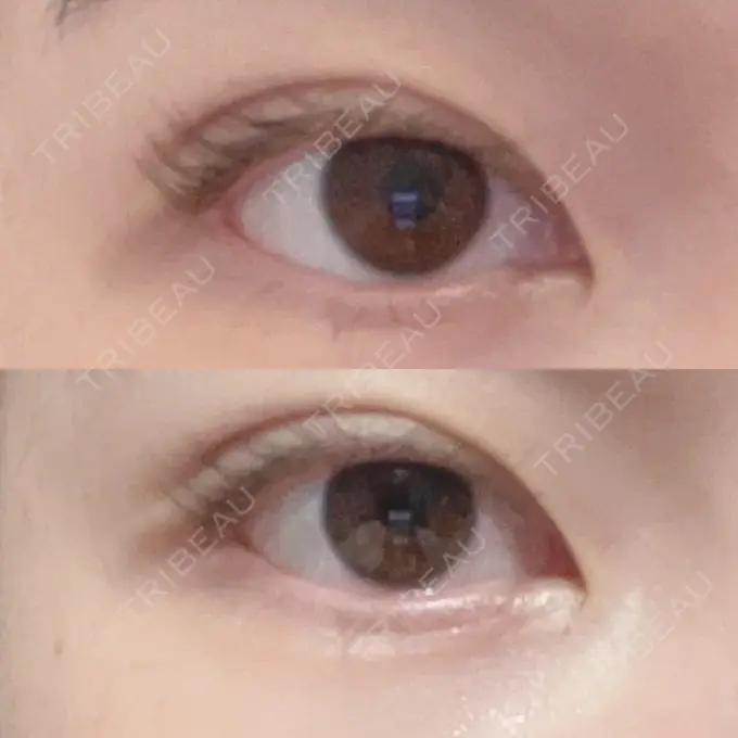 二重埋没 よだ形成外科クリニック DAY 6 メイン用