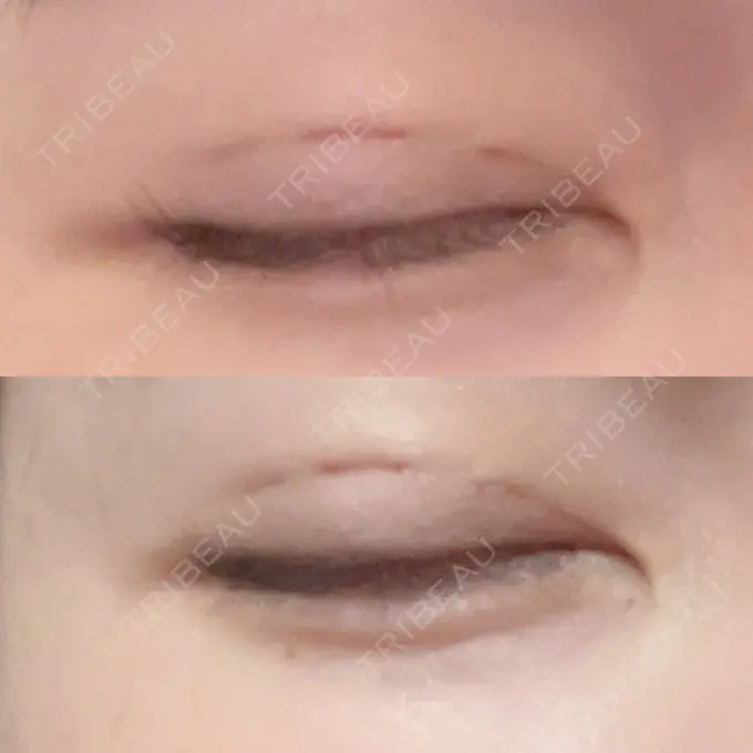 二重埋没 よだ形成外科クリニック DAY 6 メイン用