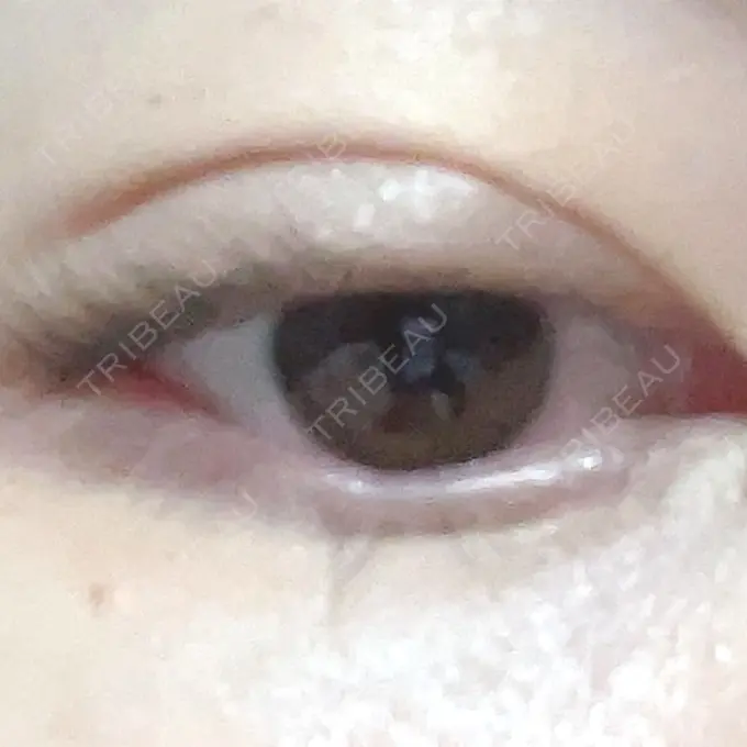 二重埋没 よだ形成外科クリニック DAY 6 メイン用