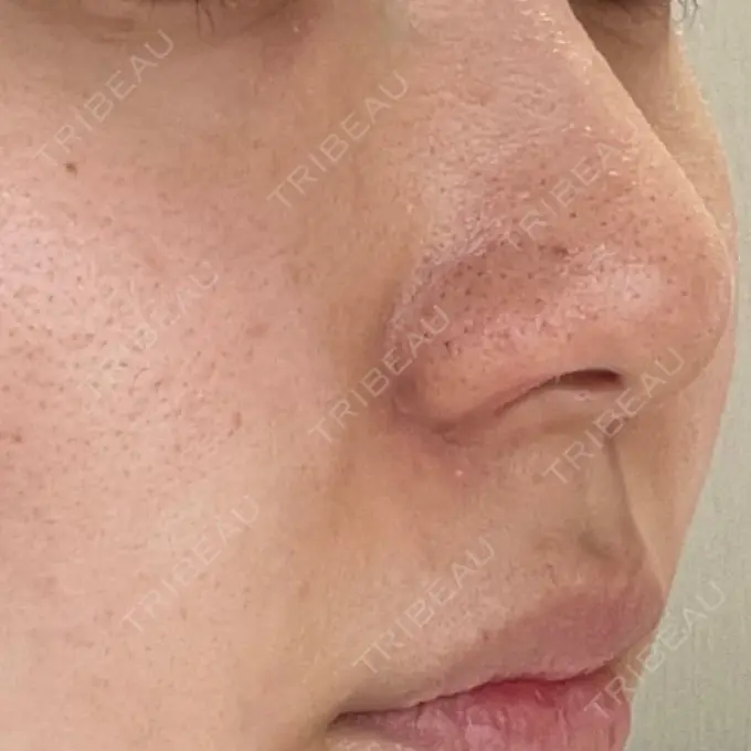 鼻孔縁挙上 シエルクリニック DAY 10 メイン用