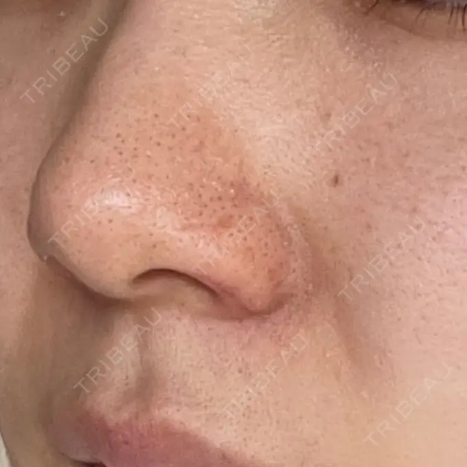 鼻孔縁挙上 シエルクリニック DAY 10 メイン用