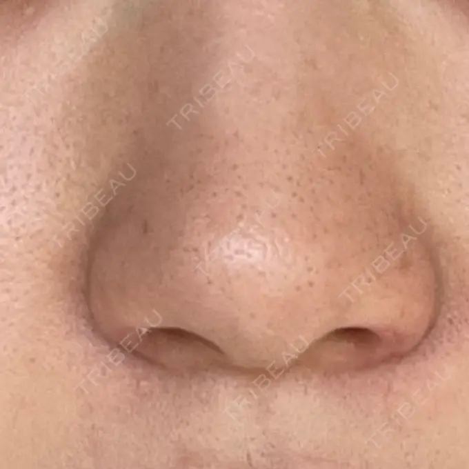 鼻孔縁挙上 シエルクリニック DAY 10 メイン用